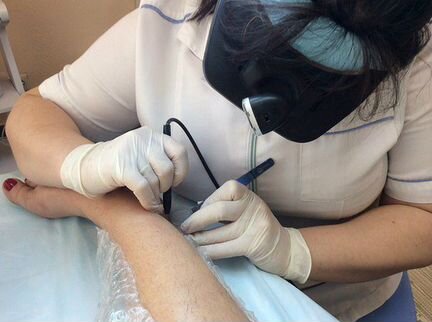 Электроэпиляция для мужчин и женщин