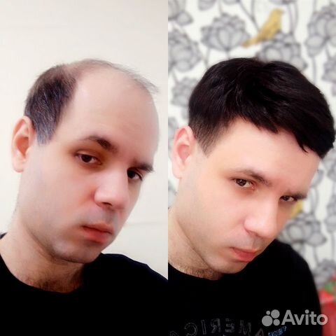 Помощь при алопеции - Системы замещения волос